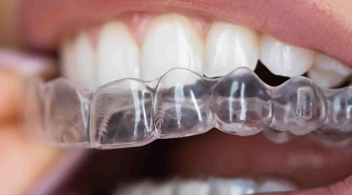 Clear aligner on teeth